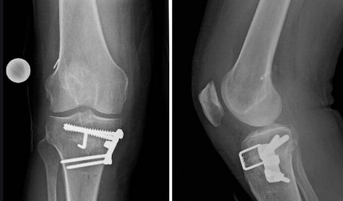 tantalum marker bands medical